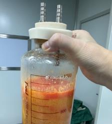 昌邑水动力吸脂手术要做多久？